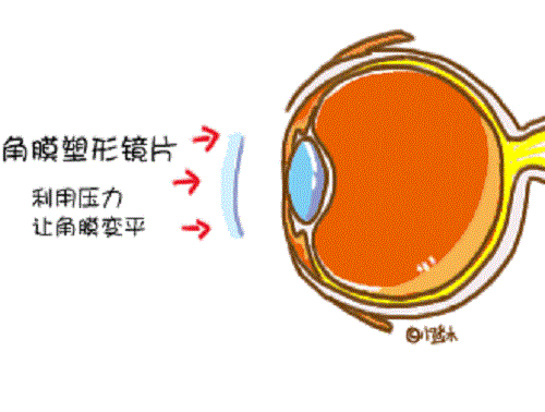 孩子近视可以不戴眼镜吗？